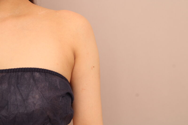 二の腕・肩の脂肪吸引 術後1ヵ月の経過