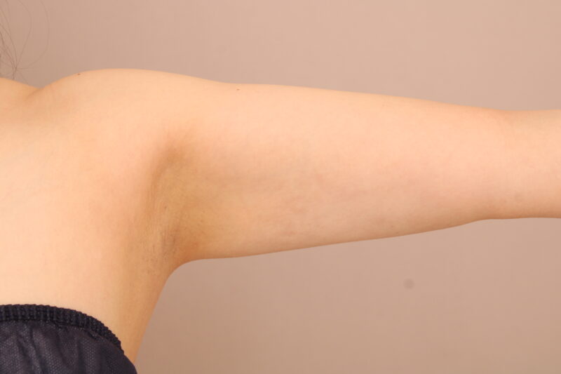二の腕・肩の脂肪吸引 術後1ヵ月の経過