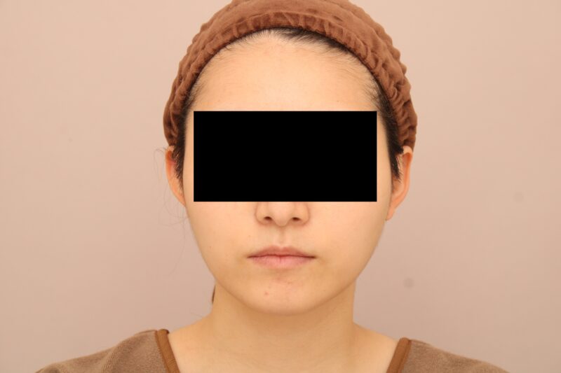 お顔の脂肪吸引 術後6カ月の経過