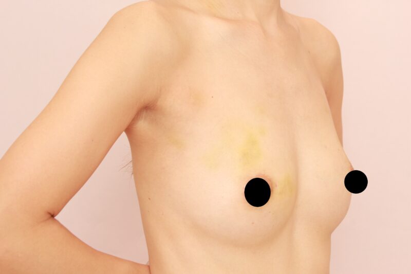 ママさんのコンデンスリッチ豊胸1か月後♡