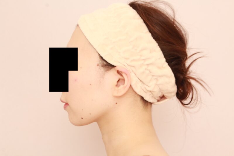 見入ってしまうような美しい横顔に♡ほほ顎脂肪吸引半年後