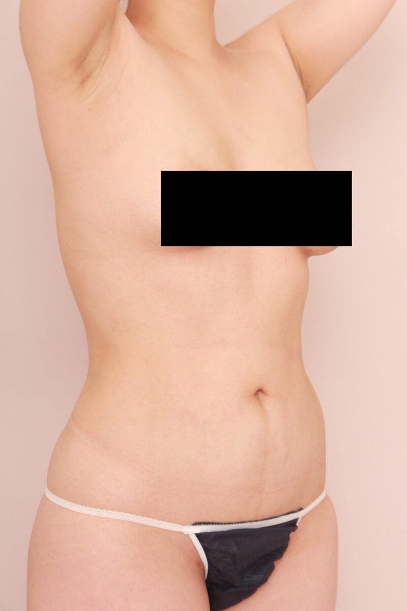 お腹・腰の脂肪吸引 術後6カ月の経過