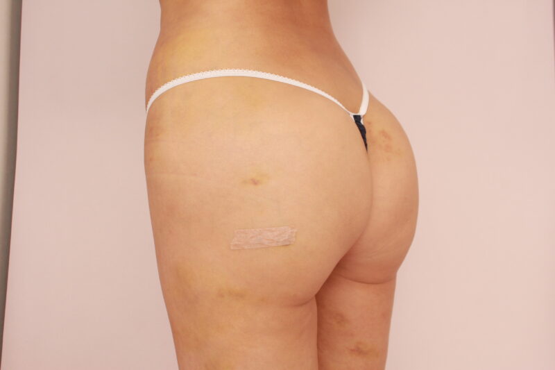 海外の方のようなお尻に♡ブラジリアンバットリフト1週間後