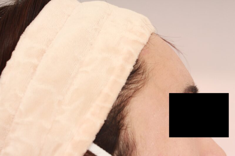 男性のオデコこめかみの脂肪注入3か月後♡