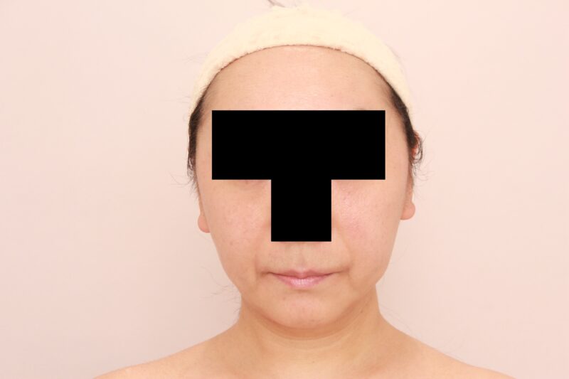 50代モニター様のほほ顎脂肪吸引のモニター様3か月後♡