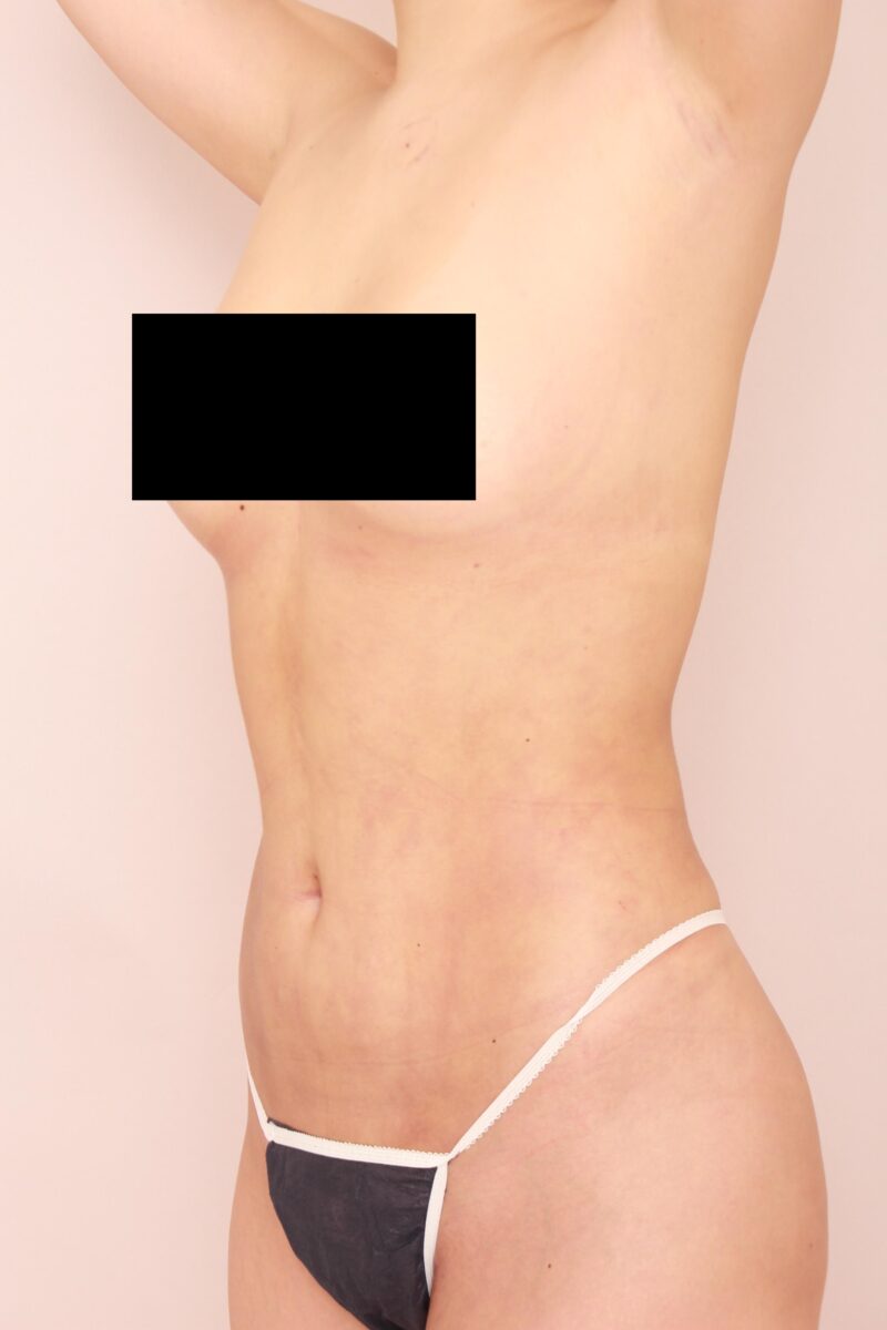 大量吸引からのブラジリアンバットリフト1か月後の変化♡