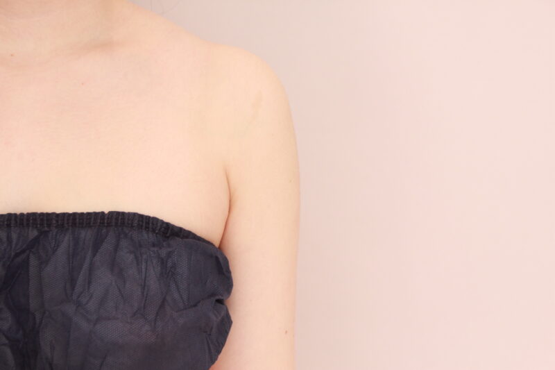 二の腕・肩の脂肪吸引 術後3カ月の経過