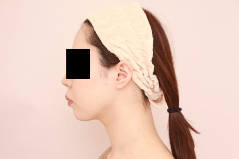 お顔の脂肪吸引 術後6カ月の経過