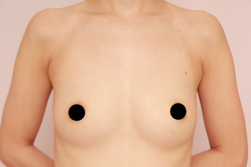 授乳経験ありのモニター様コンデンスリッチ豊胸3か月後♡