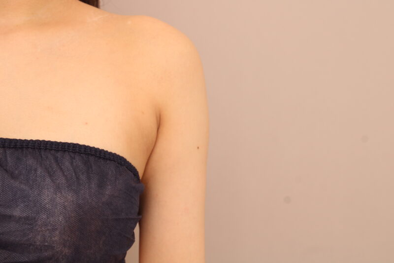 二の腕・肩の脂肪吸引 術後3ヵ月の経過