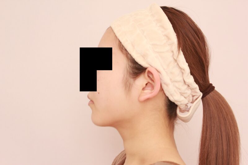 自然に!でも人生を変えるほほ顎脂肪吸引半年後♡