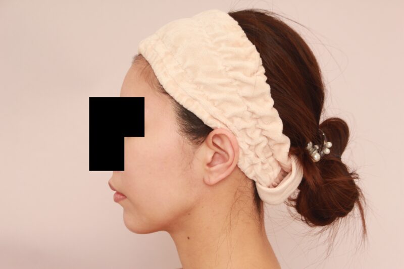 瘠せ型の方のほほ顎脂肪吸引3か月後