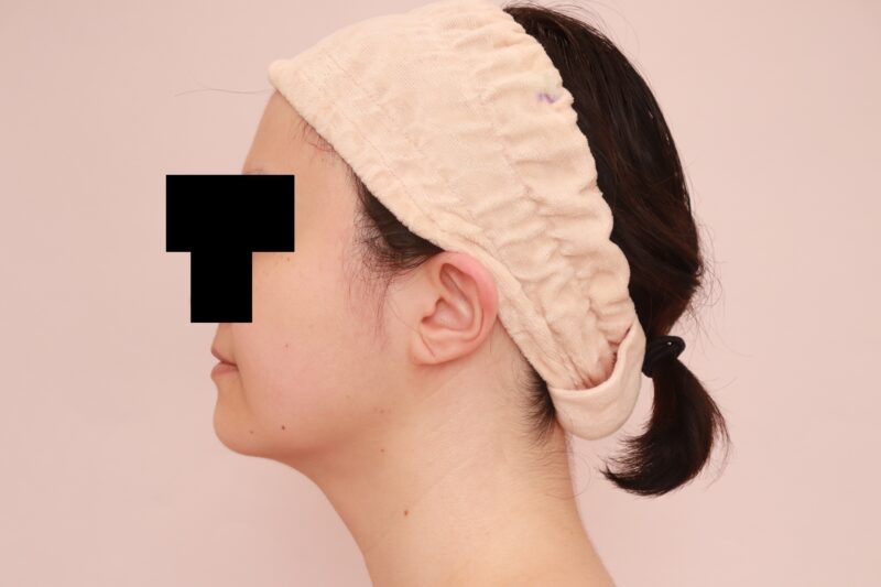 ライザッ〇が無理だった花嫁様のほほ顎脂肪吸引半年後♡