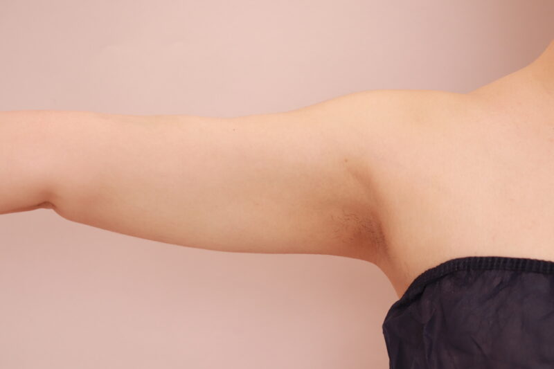 二の腕全周の脂肪吸引のモニター様半年後
