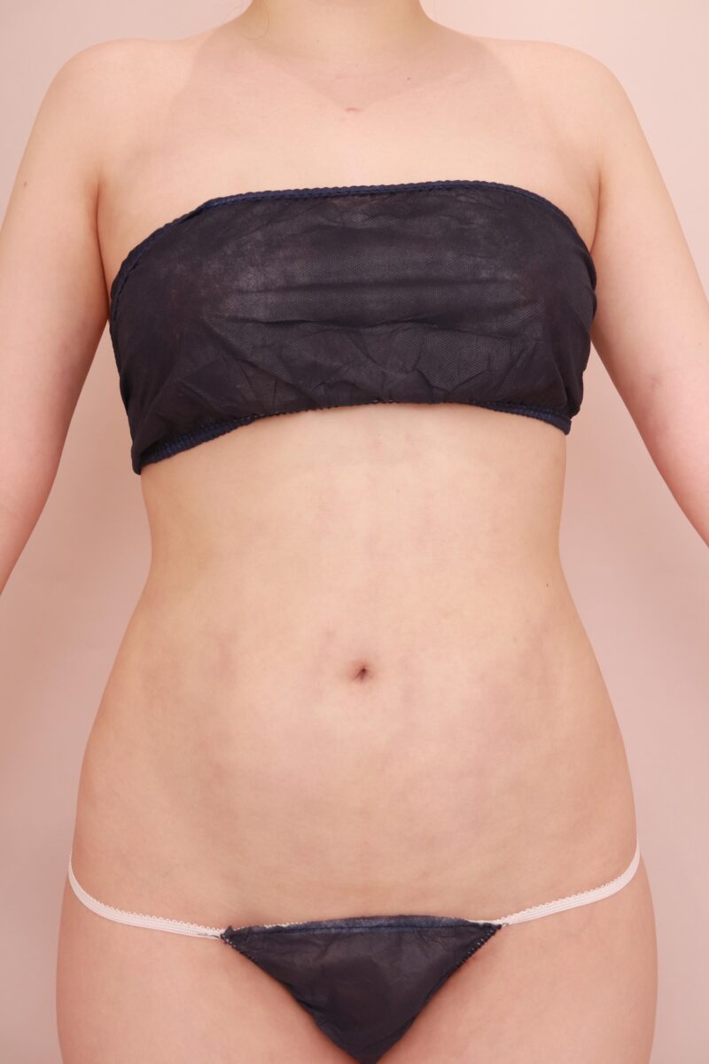 お腹全体胸下腰の脂肪吸引1か月後