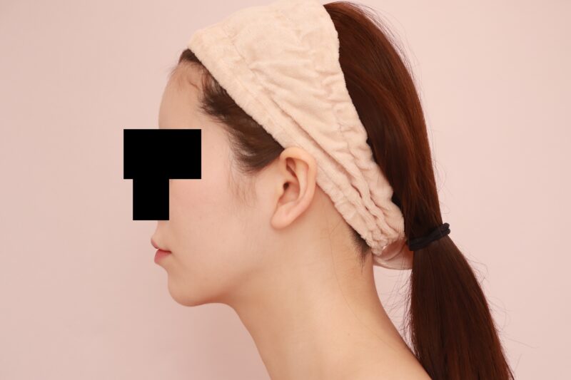 ほほ顎脂肪吸引で女優顔♪