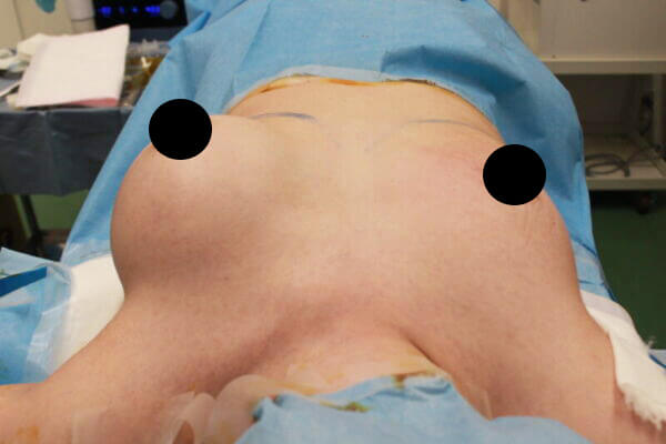 抜去後のバスト