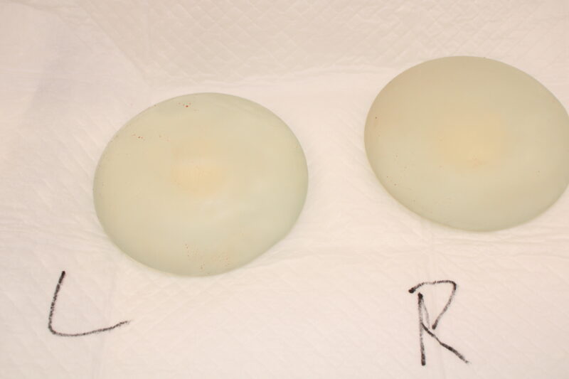 シリコンバッグ除去+コンデンスリッチ豊胸 術後1ヵ月の経過