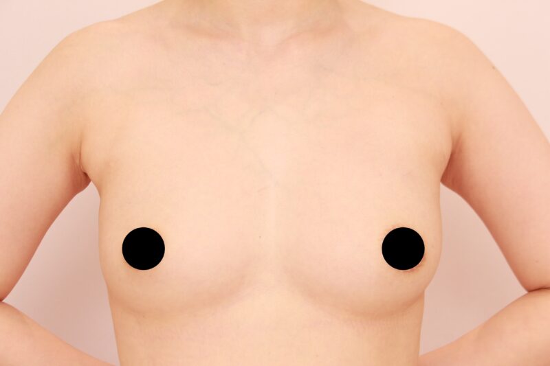 コンデンスリッチ豊胸のモニター様3か月後