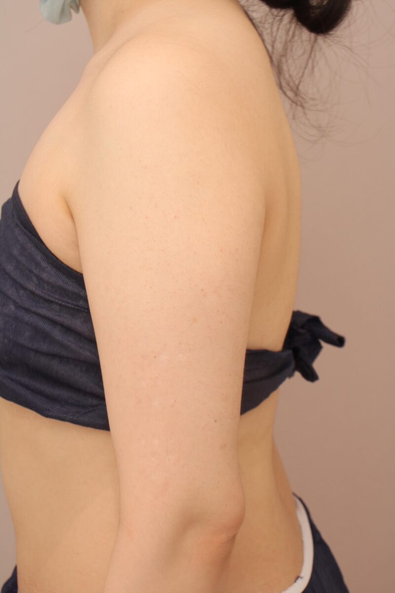 二の腕・肩の脂肪吸引 術後6ヵ月の経過