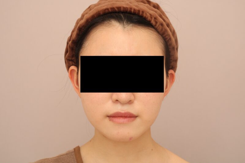 お顔の脂肪吸引 術後6ヵ月の経過