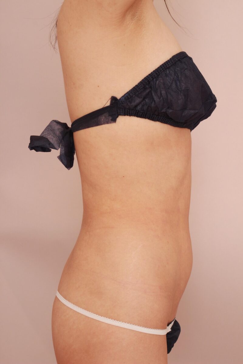 超劇的変化のお腹全体胸下腰の脂肪吸引のモニター様1年後♡