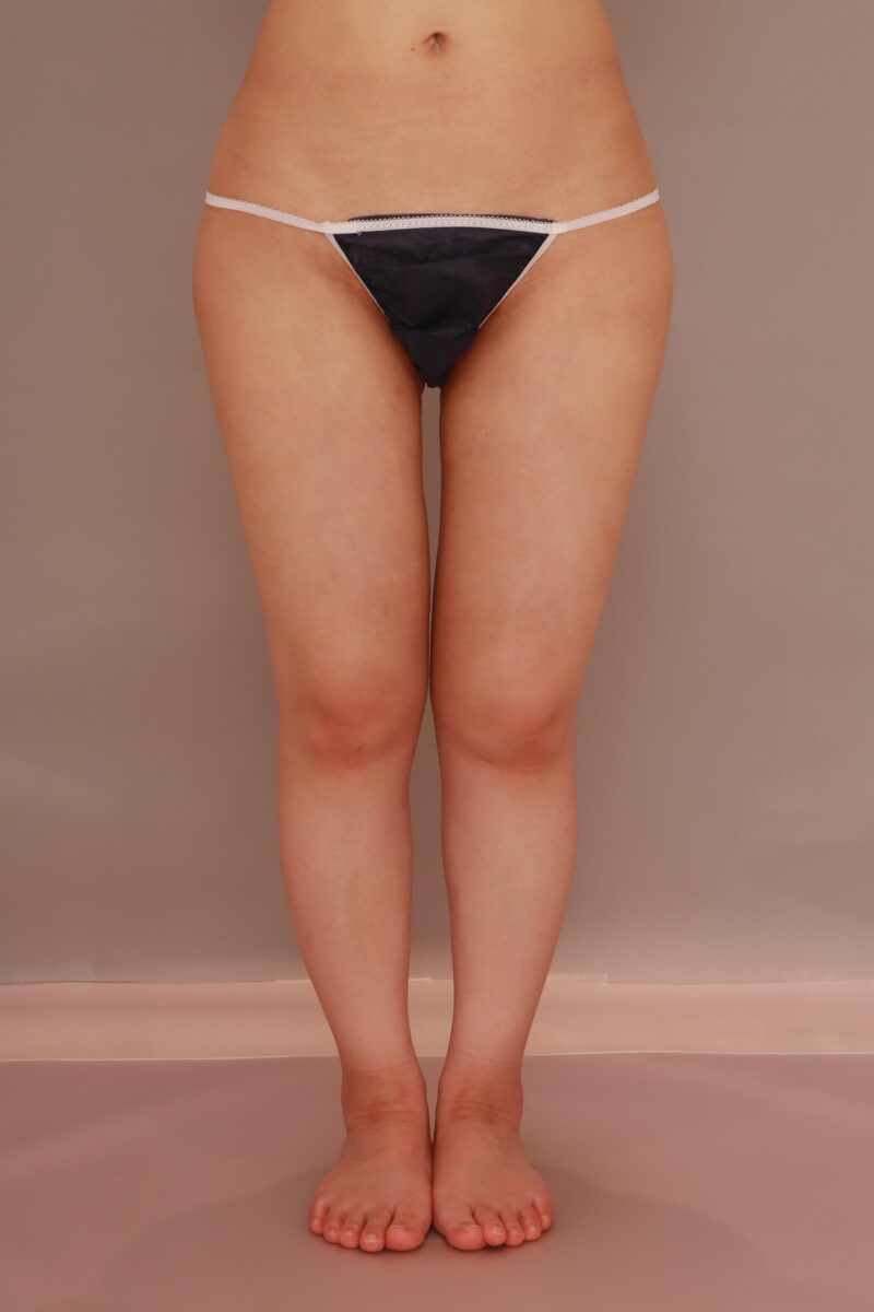 下半身の脂肪吸引1か月後♪