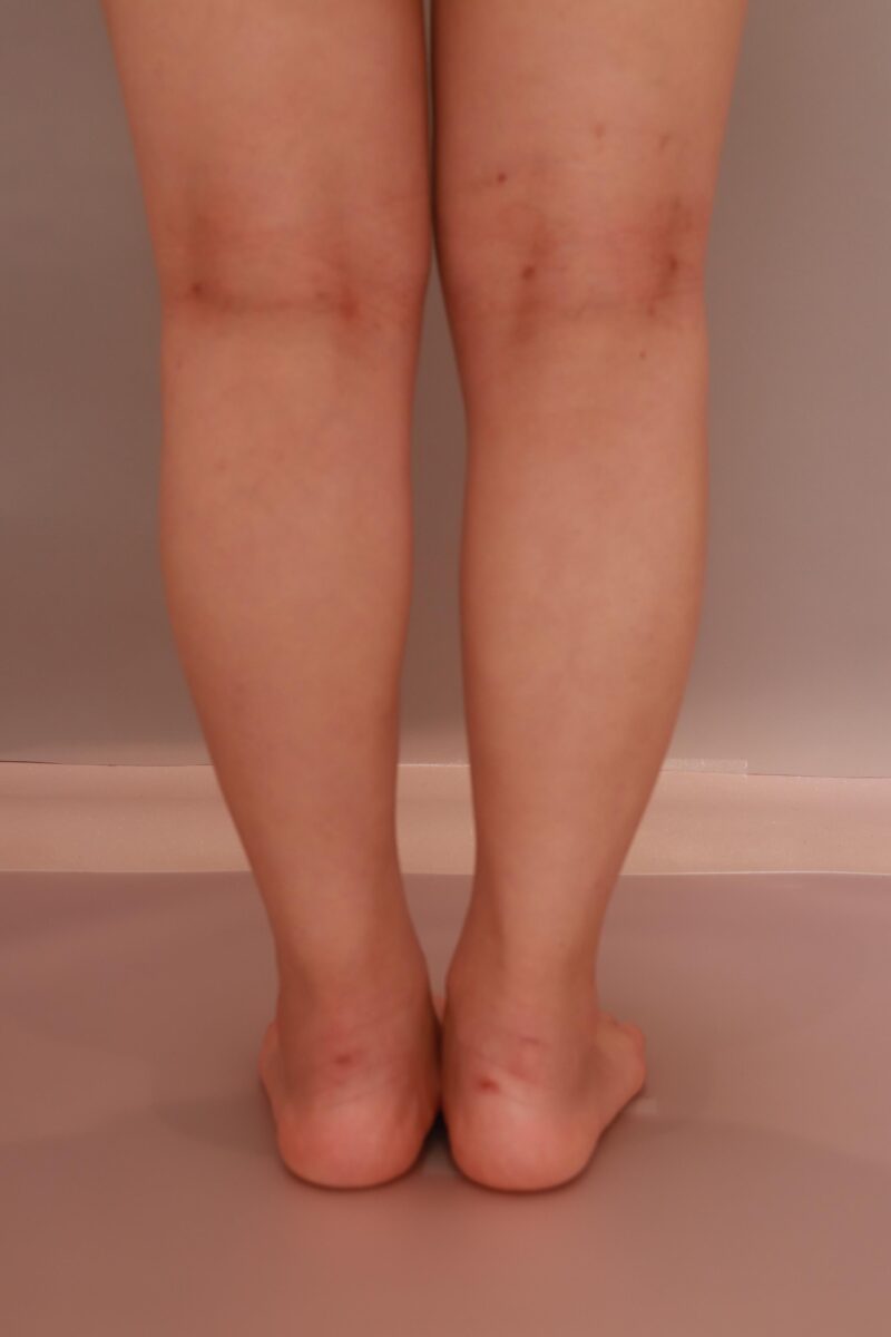 下腿足首の脂肪吸引1か月後♡