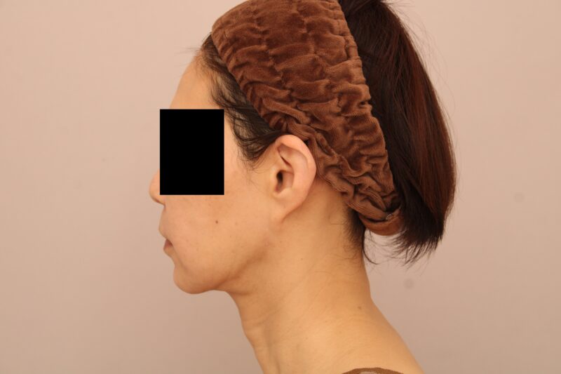 お顔の脂肪吸引 術後3ヵ月の経過