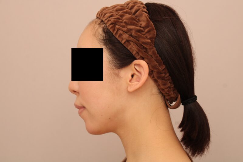 お顔の脂肪吸引 術後6ヵ月の経過