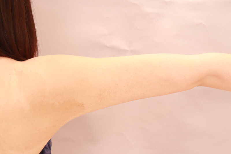 二の腕、肩のモニター様3か月後♡