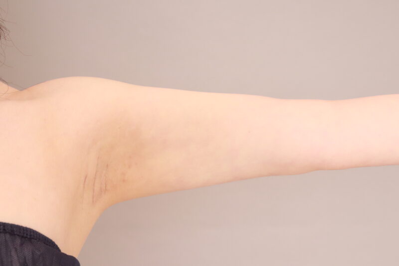 二の腕・肩の脂肪吸引 術後6ヵ月の経過