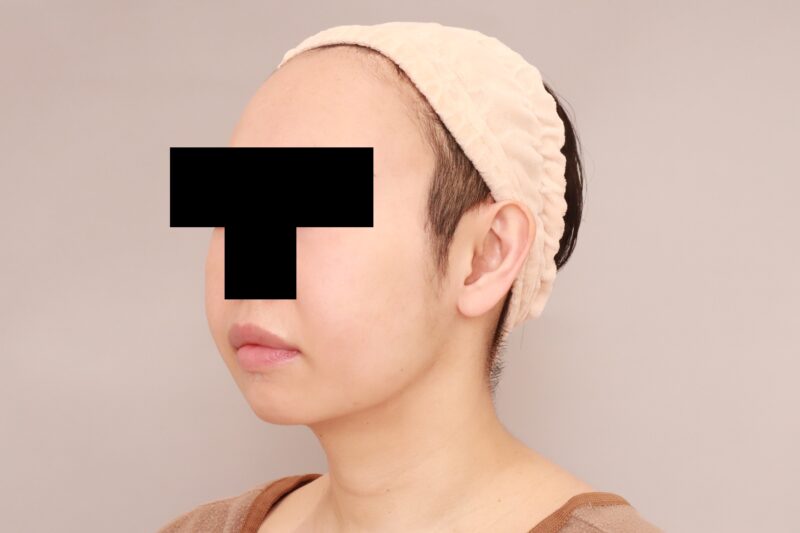 ほほ顎脂肪吸引で若返り♡モニター様3か月後