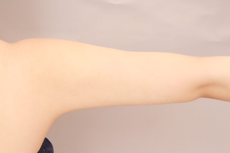 二の腕、肩の脂肪吸引1か月後♡