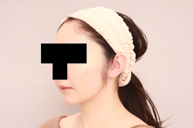 昨日のモニター様のほほ顎脂肪吸引の変化♡