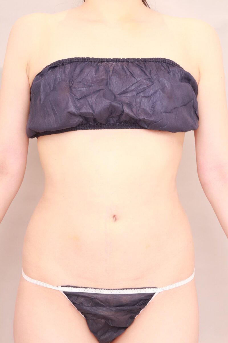 クビレがないことを気にされていたモニター様3か月後♡