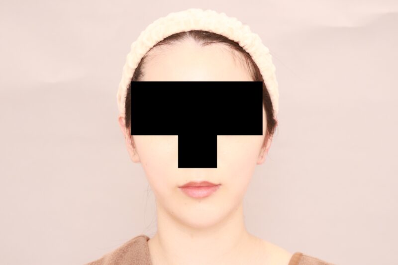 Vラインになりたい!というご希望のやせ型のモニター様のほほ顎脂肪吸引3か月後