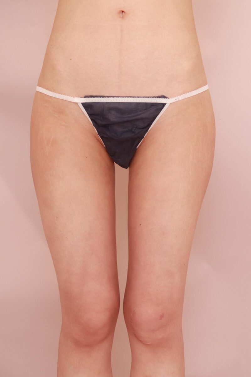 昨日の方の太もも全周お尻の変化