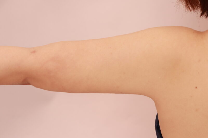 二の腕全周のモニター様3か月後♡