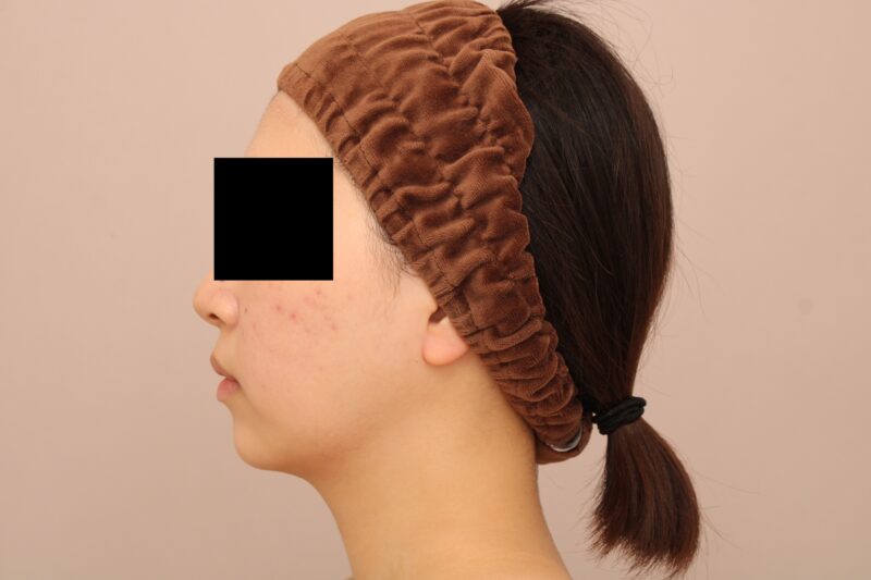 お顔の脂肪吸引 術後6ヵ月の経過