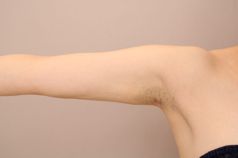二の腕・肩の脂肪吸引 術後1ヵ月の経過