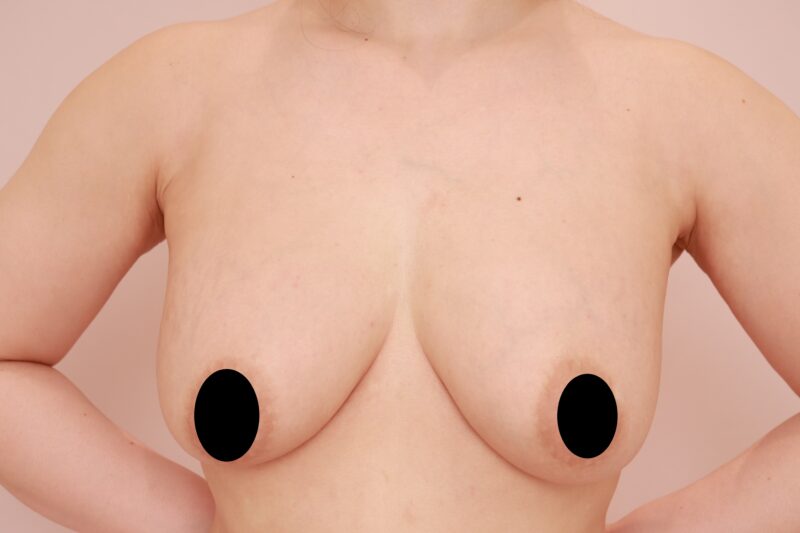 授乳後のママさんのコンデンスリッチ豊胸&脇肉脂肪吸引6か月後