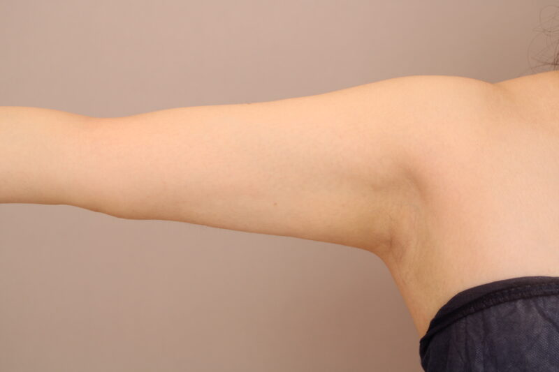 二の腕・肩の脂肪吸引 術後6ヵ月の経過