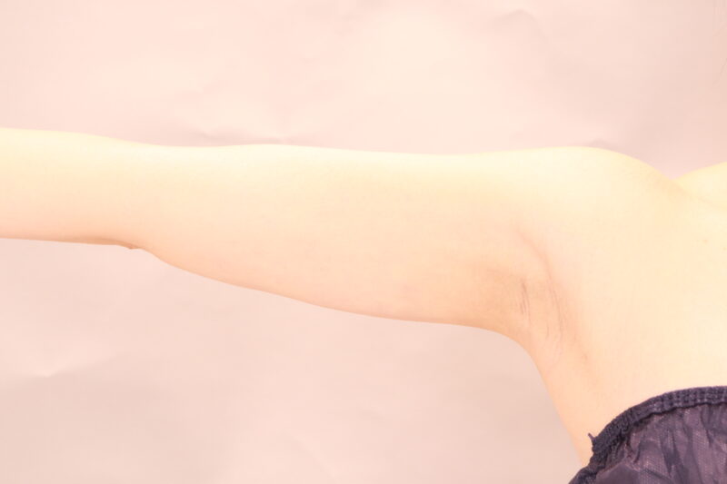 二の腕、肩の脂肪吸引3か月後♡