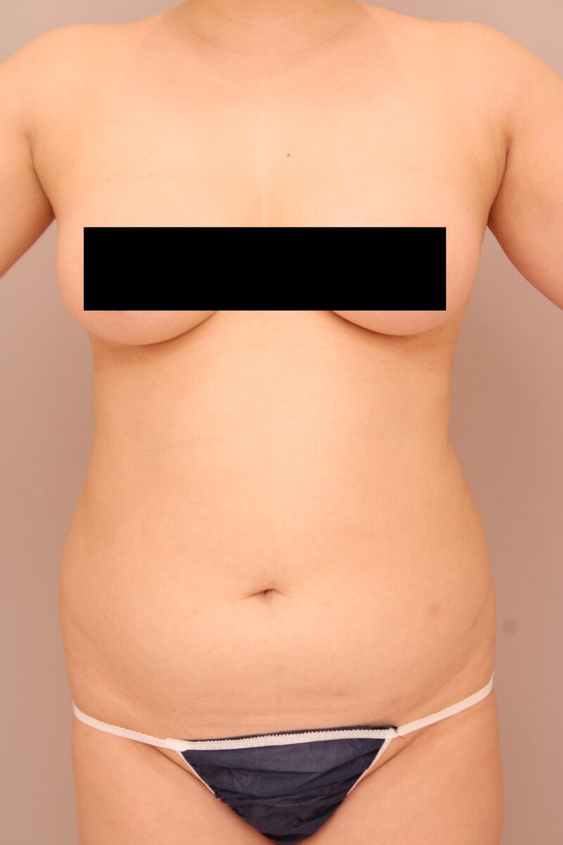 ベイザー脂肪吸引（6ヵ月経過：35）の術前写真