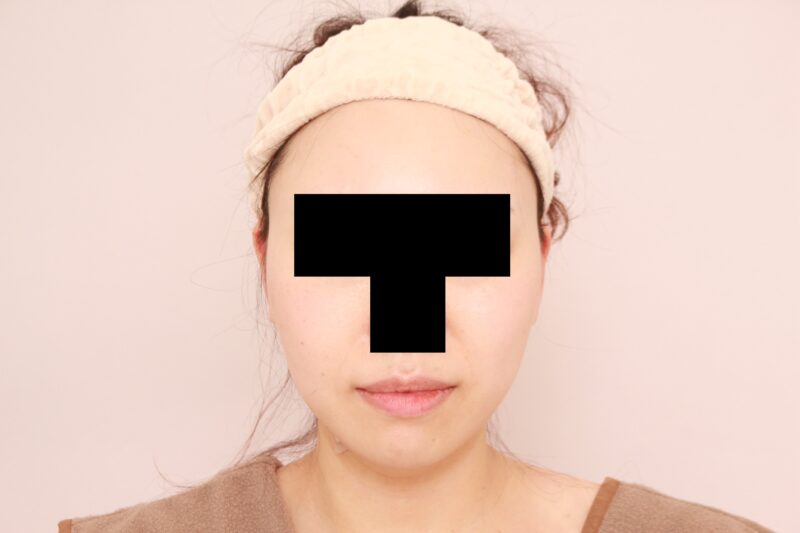 ほほ顎脂肪吸引でまっすます美人に♡