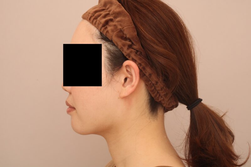 お顔の脂肪吸引 術後3カ月の経過