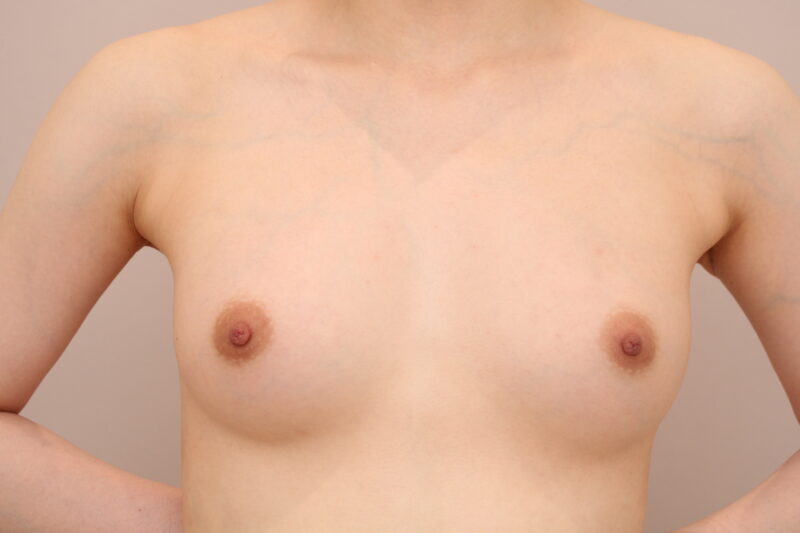 コンデンスリッチ豊胸 術後1ヵ月の経過