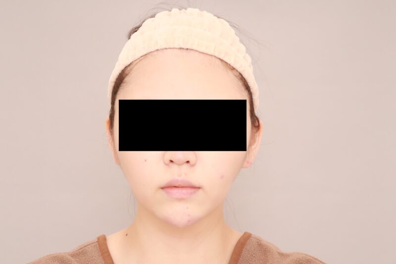 お顔の脂肪吸引 術後6ヵ月の経過