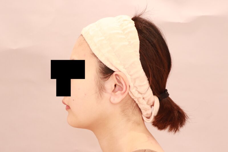 頬顎脂肪吸引の3か月後♡